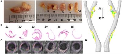 Carotid Bifurcation With Tandem Stenosis—A Patient-Specific Case Study Combined in vivo Imaging, in vitro Histology and in silico Simulation